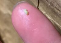 歯が欠けた 歯石 恥ずかしながら私は下の歯の裏に歯石が結構たまっ Yahoo 知恵袋