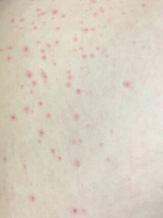 赤い 斑点 痒く ない 太もも湿疹がかゆくない時のかゆみなし逆に注意
