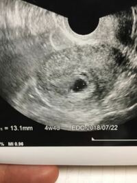稽留流産について 9月16日最終生理10月1日排卵検査薬陽性で 現在8w Yahoo 知恵袋