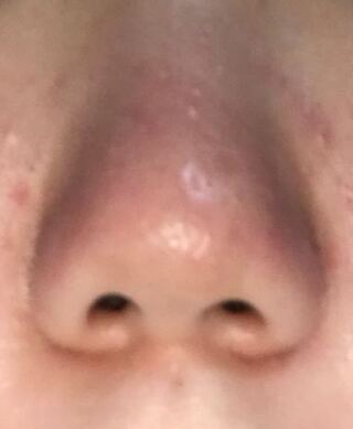 100以上 豚鼻 治った 数年で最も興味深い壁紙壁紙新日本a