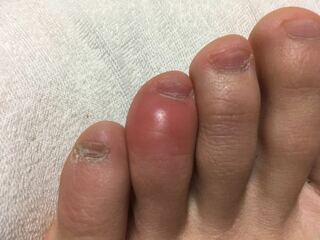 腫れ 足の指先