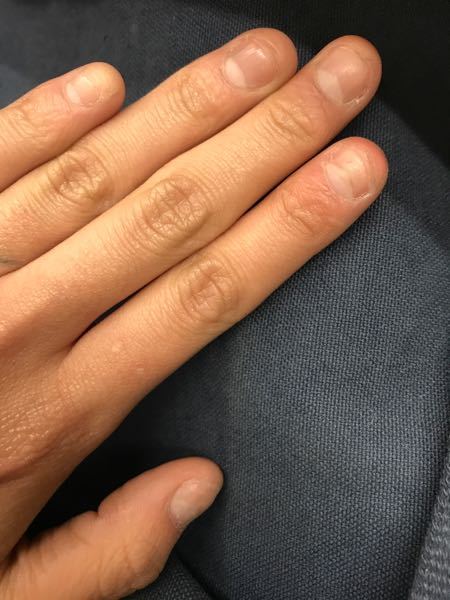ネイルサロンスカルプについて 恥ずかしながら写真の通り小さい頃から爪を噛む Yahoo 知恵袋