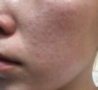 ザラザラ ブツブツ 顔 毛孔性苔癬の原因・症状を解説