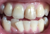 画像汚くてすみません 私の歯は間違いなく酸蝕歯ですよね 歯科医師です こ Yahoo 知恵袋