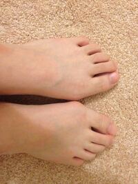 中学生男子です ちょー外反母趾なんですけどやばいですよね 治 Yahoo 知恵袋