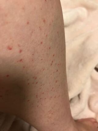 太もも 赤い 点々 かゆく ない 痒くない湿疹がお腹や腕にできる4大原因と対処法 赤い斑点やポツポツの正体とは