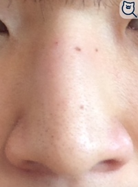 鼻が目の間まで凹んでいて かなり太いため鼻筋がなく不細工過ぎます この鼻ではモ Yahoo 知恵袋