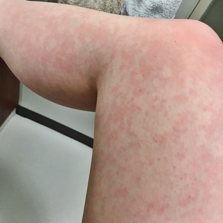 画像閲覧注意27歳女です お風呂からあがると肌が写真のようになります 汚い足 Yahoo 知恵袋
