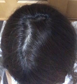 二十代女です 最近つむじ禿げが増してるような気がしてます 割とつむじ Yahoo 知恵袋