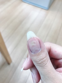 爪の真ん中の部分がへこんで白くなってます原因わかる方居ますか Yahoo 知恵袋