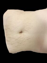 お腹の肉もすごいけど お腹の肉より この妊娠線をどうにかしたい 調べても Yahoo 知恵袋