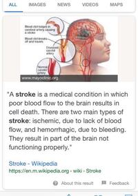 Strokeってどういう意味ですか 体がどんな状態になっているときのことですか Yahoo 知恵袋