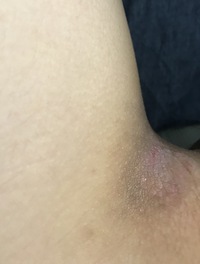 閲覧注意です アトピー持ちの女なんですが 三日前から陰部が異様に痒くて掻きむし Yahoo 知恵袋