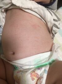 生後３ヶ月お腹のブツブツについて 生後３ヶ月の赤ちゃんのお腹に Yahoo 知恵袋