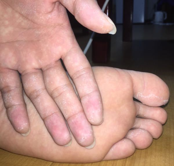 水虫 解決済みの質問 Yahoo 知恵袋