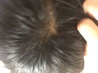 中学生です 入院してから一週間なんですけど 抜け毛がやばいです Yahoo 知恵袋