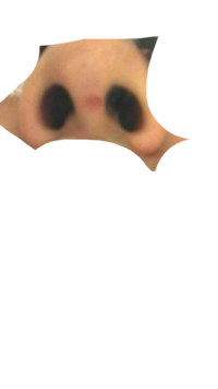 昨日タバコを吸っていたら不可抗力で鼻の穴と穴の間に押し付けてしまい Yahoo 知恵袋