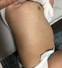 赤ちゃんの足に小さな内出血のような痣が1つできました 生後5ヶ月の子供で Yahoo 知恵袋