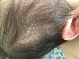乳児の頭のフケ について生後1ヶ月半ですが 頭皮が白くバリバリになっ Yahoo 知恵袋