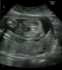 妊娠六カ月です 性別は股に何もついていない 線があるとのことで女の Yahoo 知恵袋