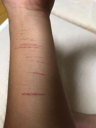 最近嫌なことが重なり彫刻刀でリスカしてしまいました 明日は学校があり 体育もあ Yahoo 知恵袋