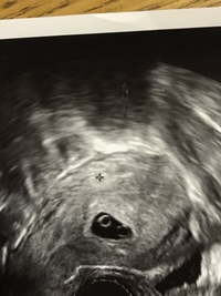今妊娠5週目に入った所でまだ確定ではないけど 一卵性の双子かもしれないと言われ Yahoo 知恵袋