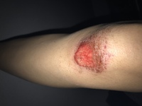 画像閲覧注意 至急 2日前くらいに自転車で転び擦り傷をおってしまったんです Yahoo 知恵袋