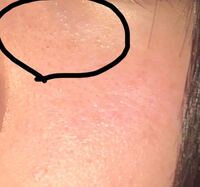 目の下が 毛穴というより凸のようになっています またそこがクマのように黒く見え Yahoo 知恵袋