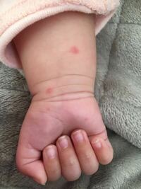 生後3ヶ月の赤ちゃんですが 朝起きたら手に赤い発疹ができていました 突発はまだ Yahoo 知恵袋