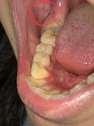 閲覧注意です 頬の内側の肉 歯茎 が 歯の形がついています Yahoo 知恵袋