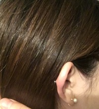 軟骨ピアスのしこりについて今年の6月にピアススタジオでヘリックスにホールを開け Yahoo 知恵袋