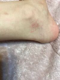 手のひらなどに赤い血管のようなものが浮き出ていて 痛くも痒くもないの Yahoo 知恵袋