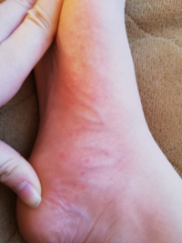 起きたら足の裏が痒くて見てみたら見にくいですがこんな感じに赤い斑点模 Yahoo 知恵袋