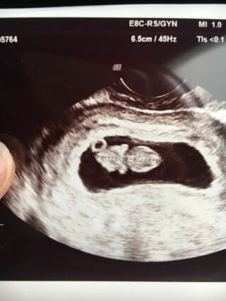 妊娠9週2日です エコー写真頭がとがっている 今日検診に行った Yahoo 知恵袋