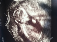 14週のエコー写真なんですけど鼻骨がうつってないですよね すごく平坦な顔で色 Yahoo 知恵袋