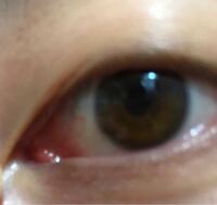 両目の内眼角 が膨れて白い点々ができてます 疲れなどで腫れたのでしょうか Yahoo 知恵袋