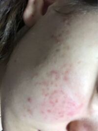 最近肌荒れが酷くて皮膚科に行ったんですけどまだ治らないんですよ どうすれば Yahoo 知恵袋