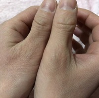 ピクピク 親指 右手の親指が勝手にピクピク動くようになり、とまりませんこれはどういう症状なの