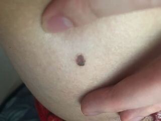 だらしない ステープル 光電 脇腹 ほくろ たくさん Kegahaeru Jp