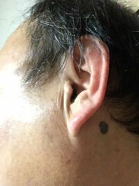 耳 の 後ろ の ホクロ