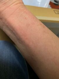 最近 右手の手首らへんが痒くなりボリボリかくと写真のようになります Yahoo 知恵袋