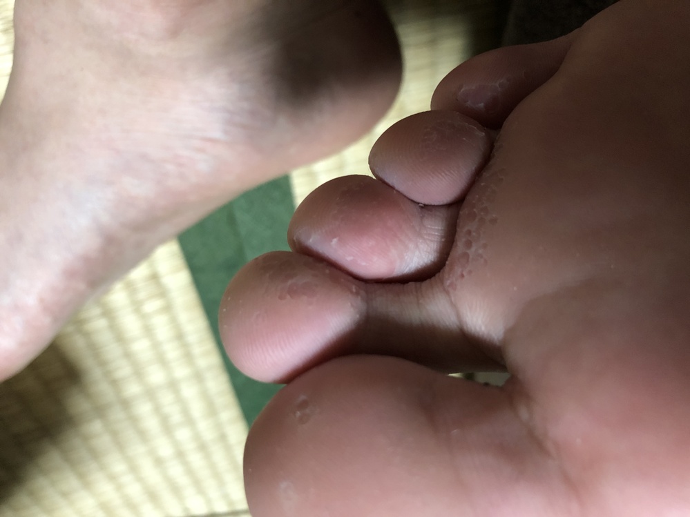 水虫 ゲンタシン