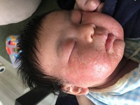 ２ヶ月の赤ちゃん顔に白いフケ 鱗 乾燥 皮剥けのようなガサガサ Yahoo 知恵袋
