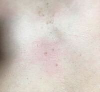 写真閲覧注意 中学生女子です 3年ほど前から胸の間にできものができ Yahoo 知恵袋