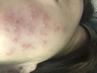 画像あり 閲覧注意 妊娠中期からのニキビに悩んでいます 今妊娠17 Yahoo 知恵袋