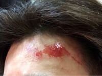 これは一体なんですか パーマをかけたらこうなりました 赤くジュクジュクしていて Yahoo 知恵袋