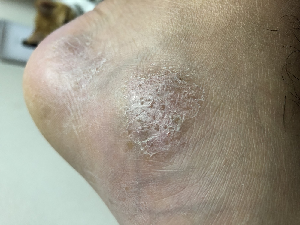 水虫 解決済みの質問 Yahoo 知恵袋