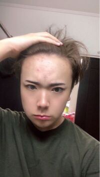 16才男子です ぼくはこの広いおでこがコンプレックスです 周りの人より Yahoo Beauty