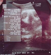 33週でのエコー写真です 性別がまだはっきりしないのですが 男の子 女の Yahoo 知恵袋