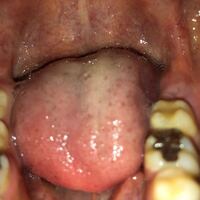 歯茎の腫れが気になります親知らずの奥の腫れはなんでしょうか 来月親知らず Yahoo 知恵袋